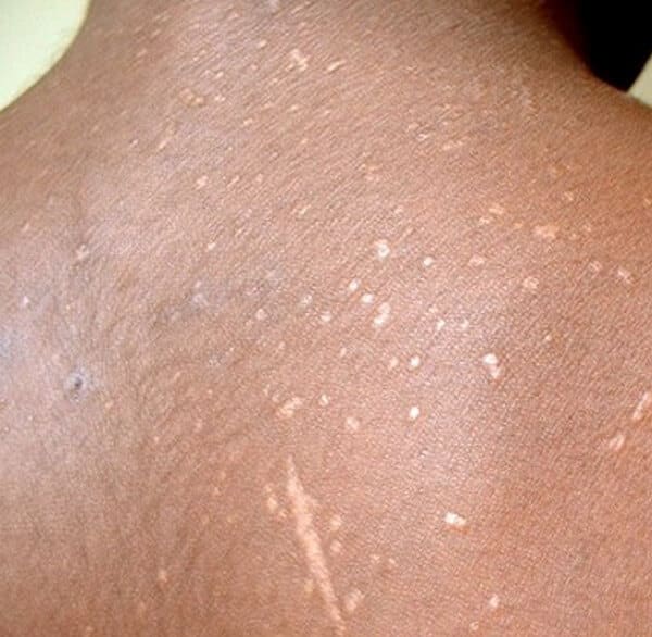 Hiv Black Spots On Skin