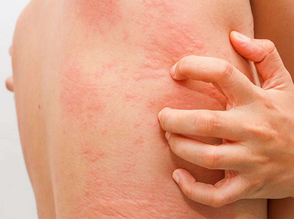 Hives: 10 Symptoms of Hives