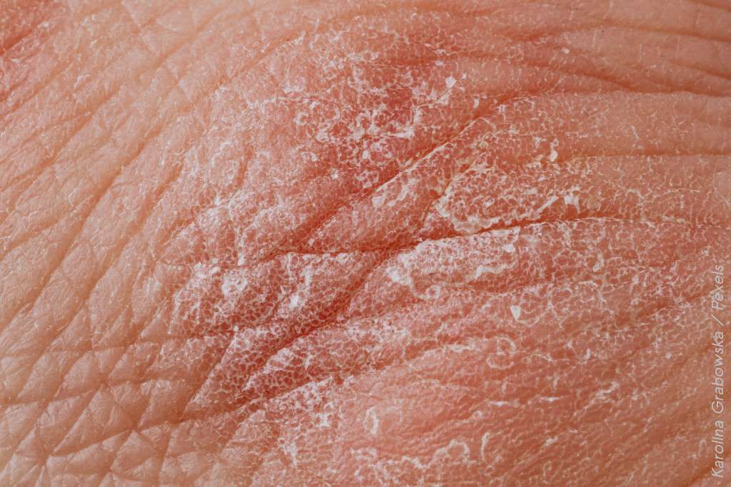 Homemade recipes to deal with dry patches of skin