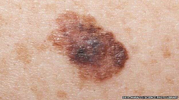 Hospitals see rapid rise in skin cancer