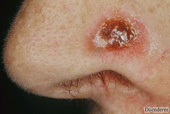 How Bad Is Basal Cell Skin Cancer