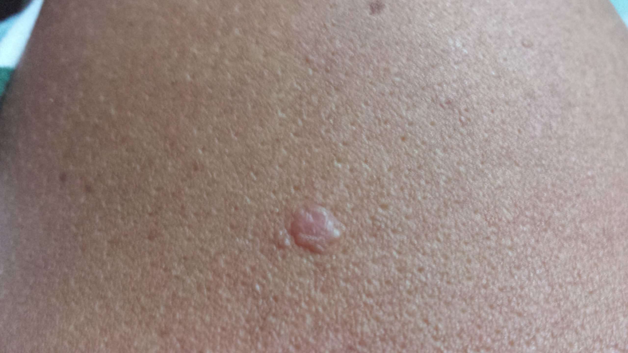 How can I tell if this is skin cancer?