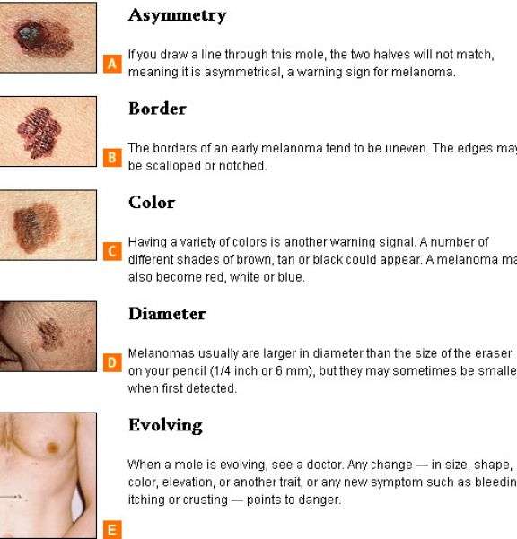 How can you tell if you have skin cancer