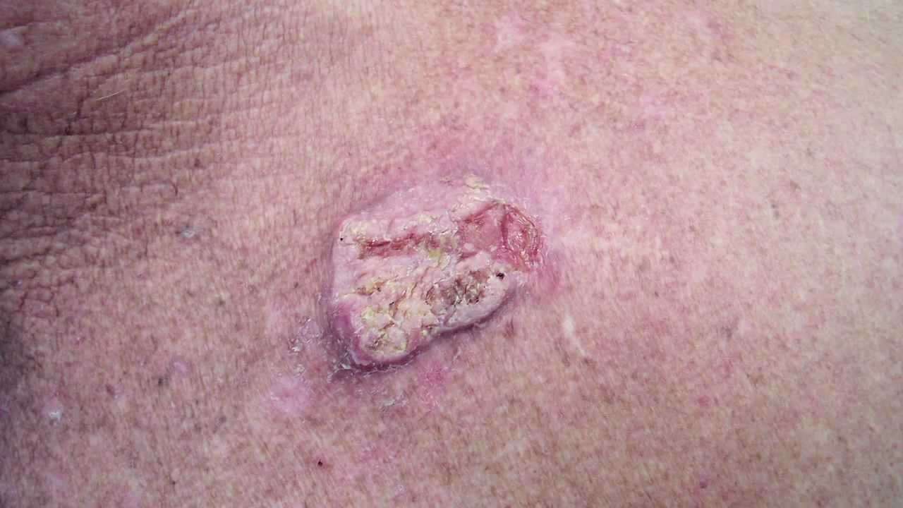 How Dangerous is Squamous Cell Carcinoma?