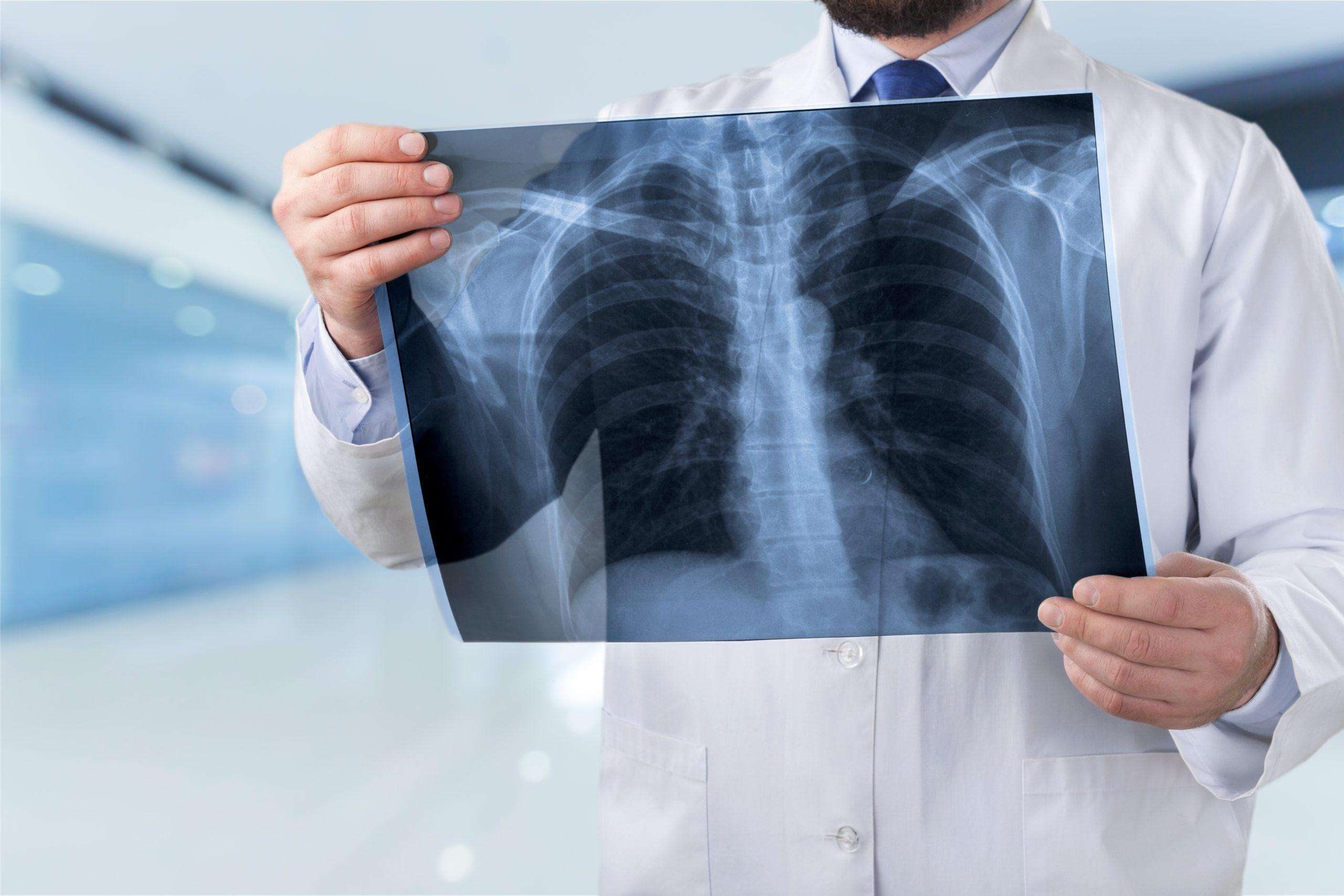 How Do Doctors Check for Mesothelioma Lung Cancer?