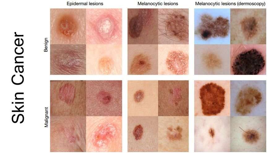 How Does Skin Cancer Look Like