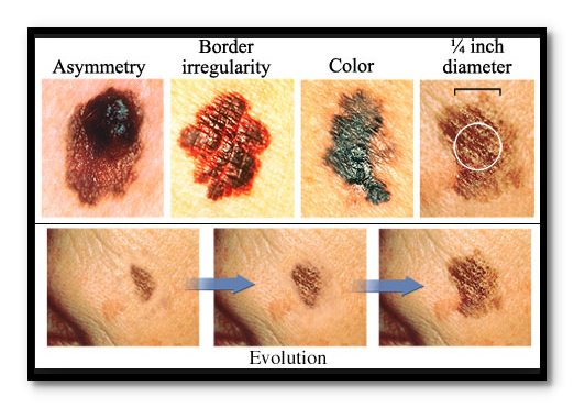 How Does Skin Cancer Start? ~ Cancer and Cancer Treatment