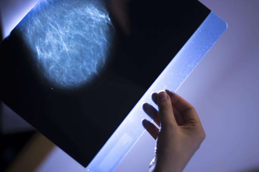 How fast can breast cancer spread in 1 year?
