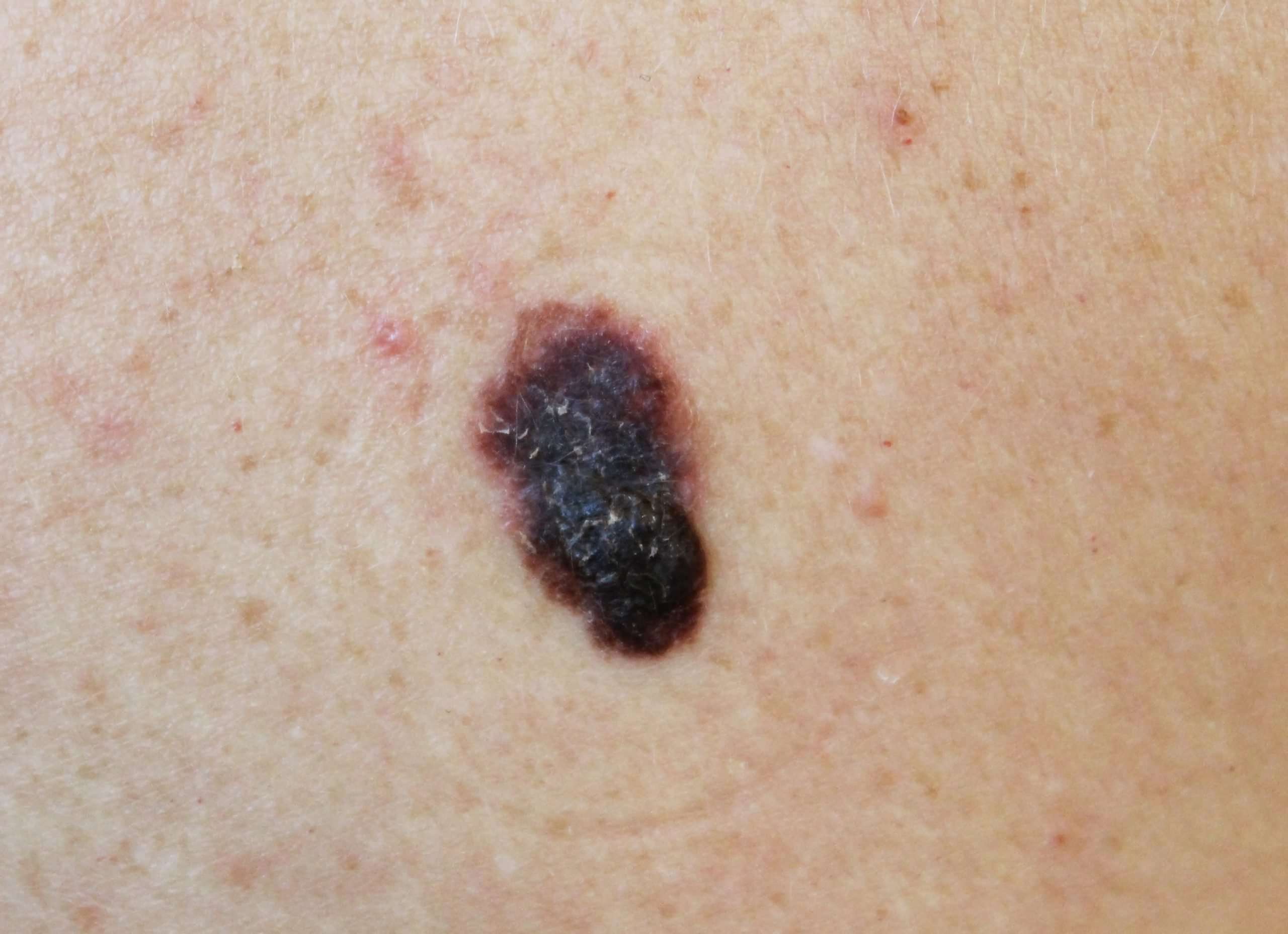 How Fast Can Melanoma Spread After It First Appears? » Scary Symptoms