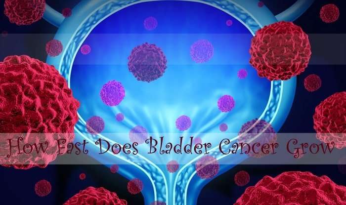 How fast does Bladder Cancer Grow [Read 5 Step]
