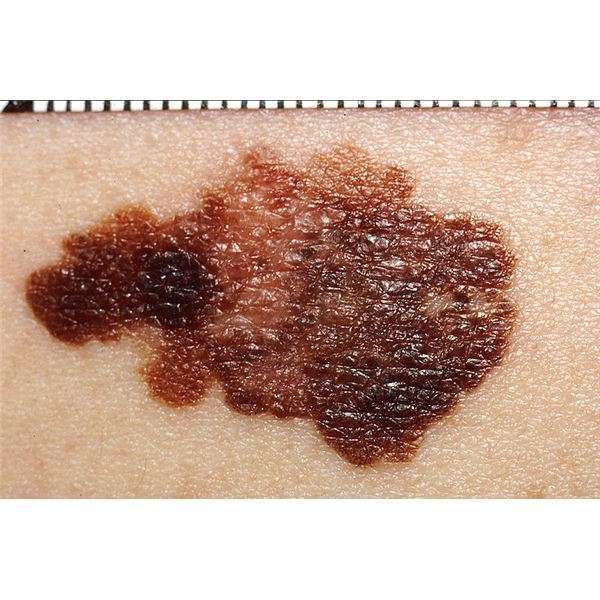 How Fast Does Melanoma Spread and What Should I Know About this Skin ...
