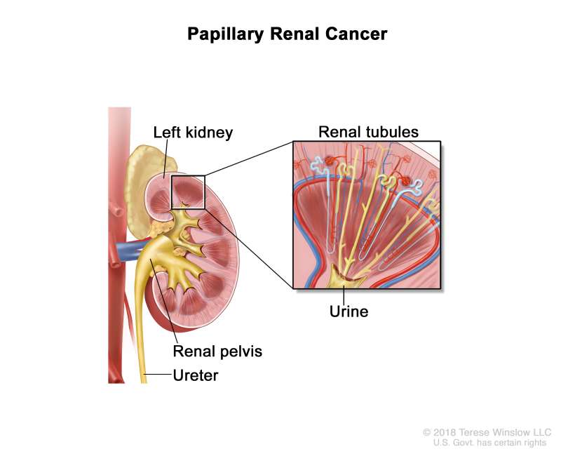 How Fast Does Renal Cancer Grow