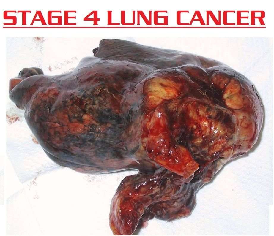 How Long Can You Live With Lung Cancer Stage 4