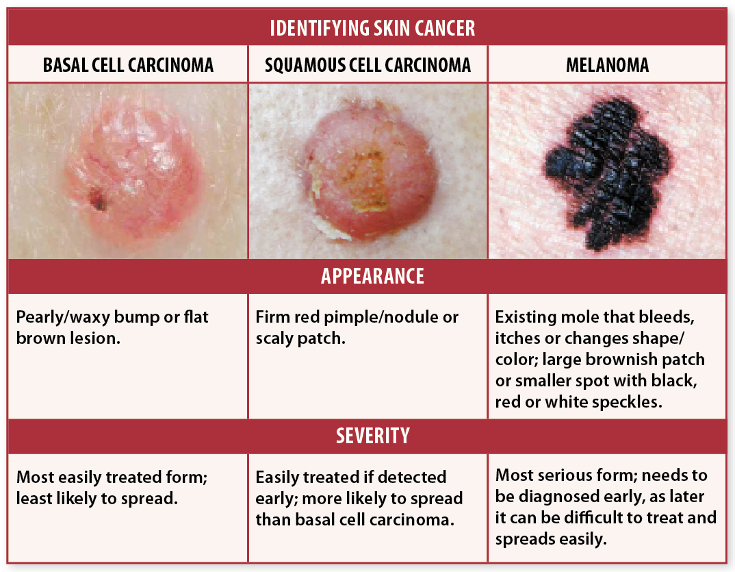 How Long Does It Take For Skin Cancer To Spread ...