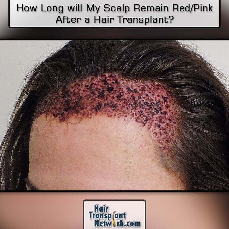How Long will My Scalp Remain Red/Pink After a Hair Transplant?