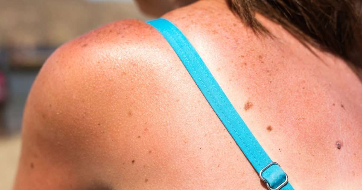 How many sunburns does it take to get skin cancer?