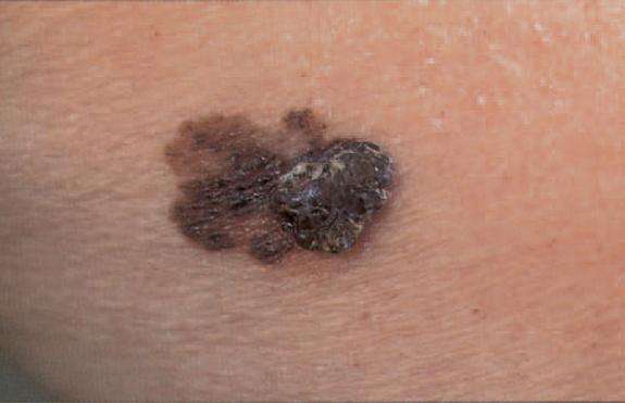 How melanoma can spread from your skin to your brain