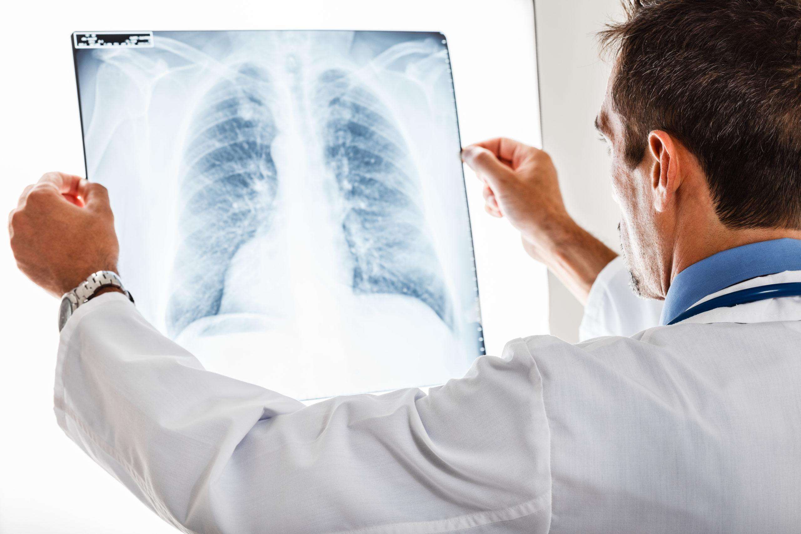 How Quickly Do Symptoms Progress in Lung Cancer?