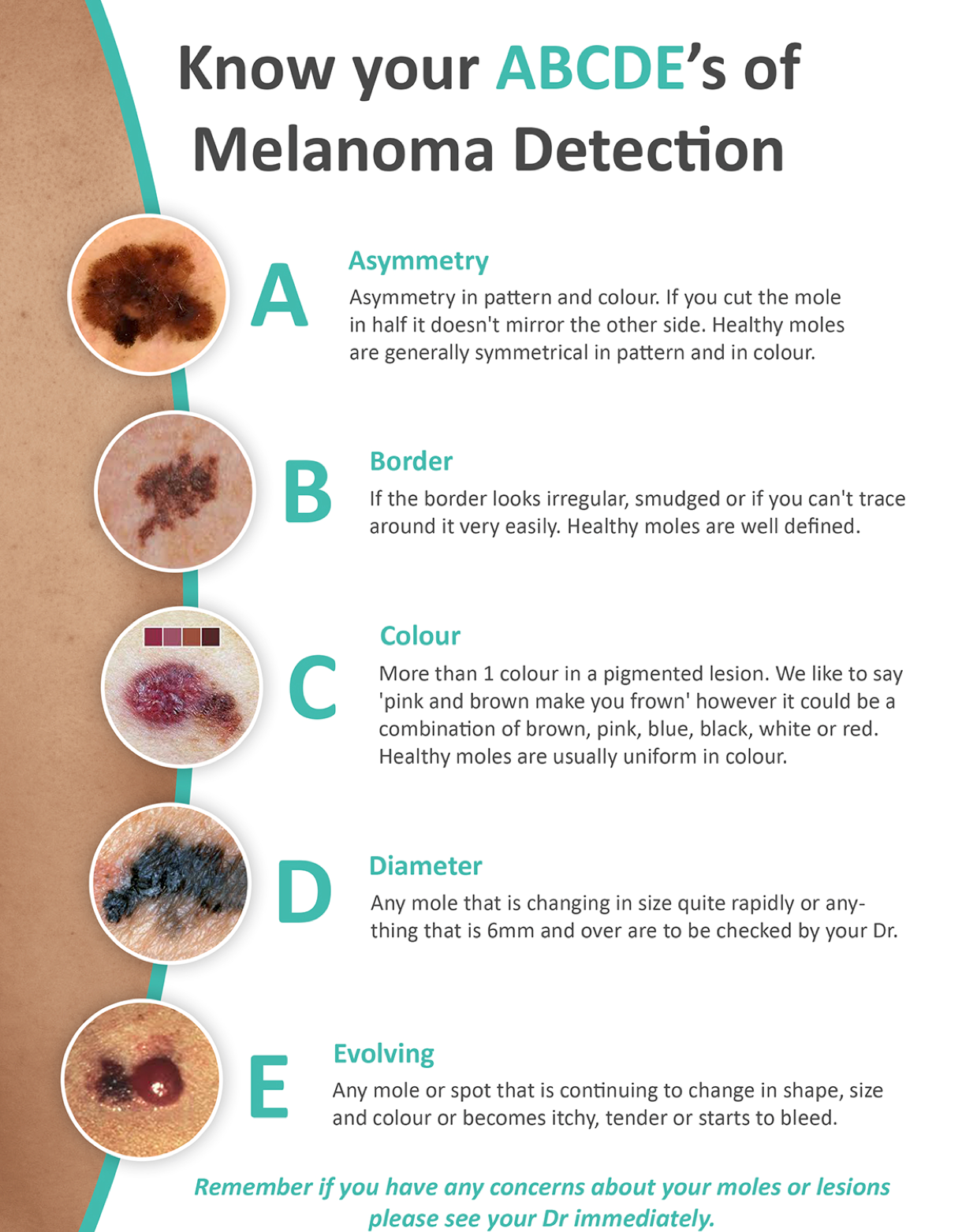 How to check your moles and freckles for melanoma