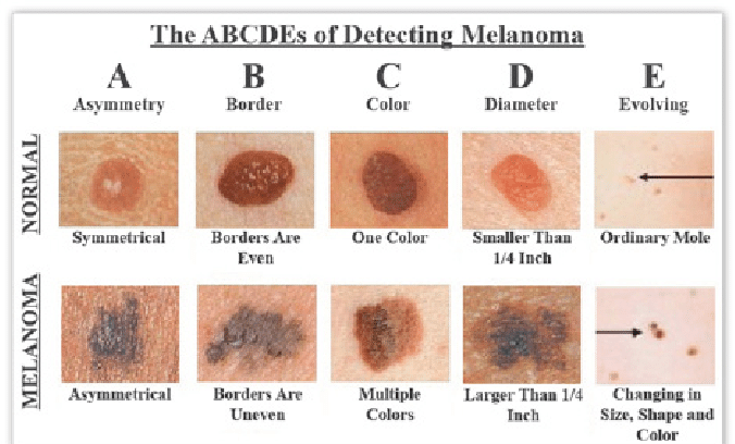 How to Detect Melanoma Source:The Skin Cancer Foundation ...