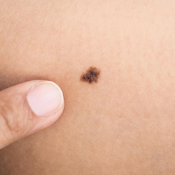 How To Detect Skin Cancer On ClientsAnd What To Say If You Do