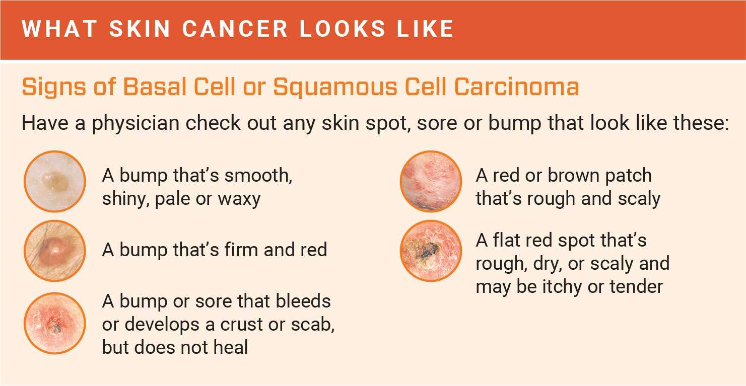How to Detect Skin Cancer