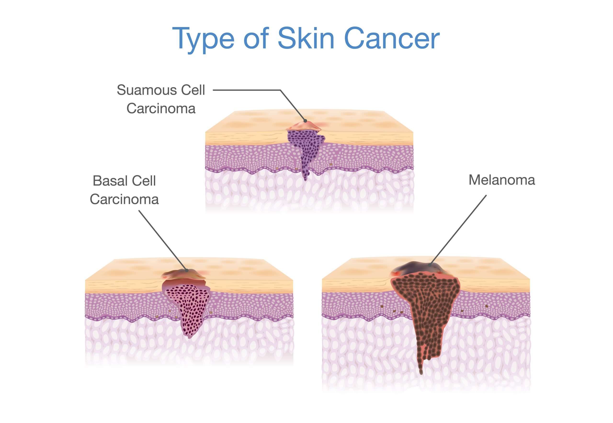 How to Detect the Different Types of Skin Cancer