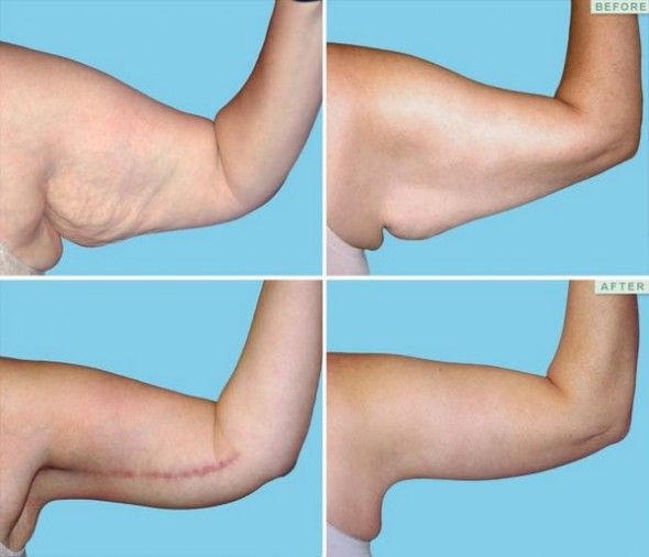 How To Fix Flabby Upper Arms