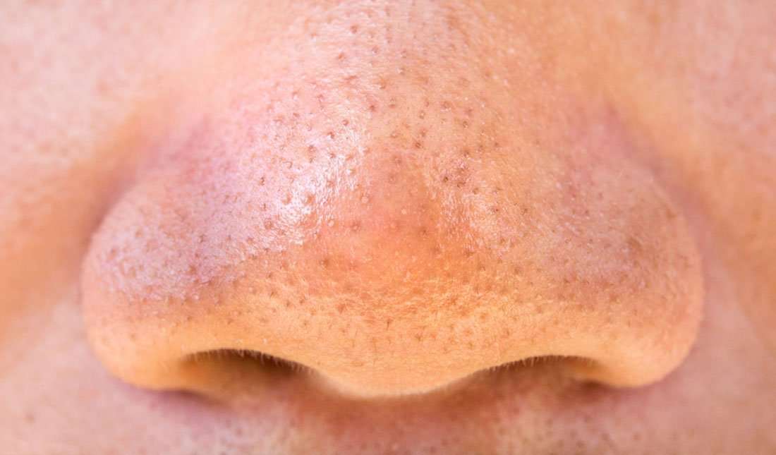 How to get rid of a spot on nose