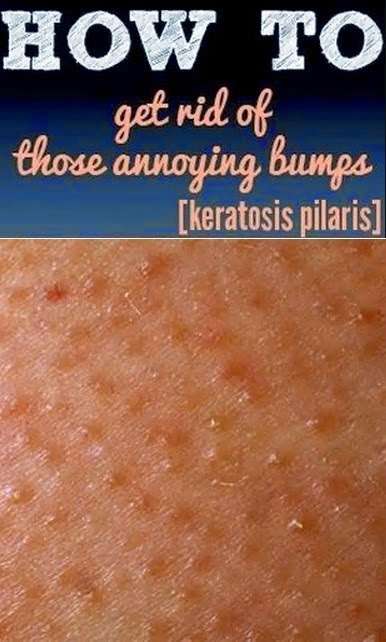 How To Get Rid Of Arm Bumps a.k.a keratosis pilaris or Chicken Skin ...