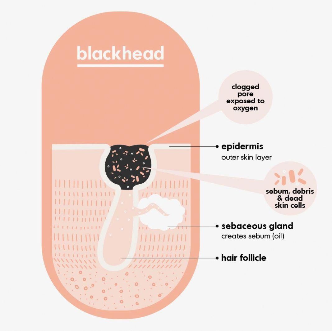 How to get rid of Blackheads, skin care tips, get rid of Blackheads and ...