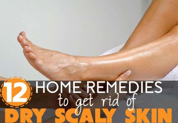 How to Get Rid of Dry Scaly Skin on Legs