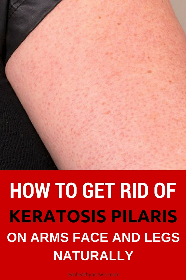 How to Get Rid of Keratosis Pilaris on Arms Face and Legs Naturally ...