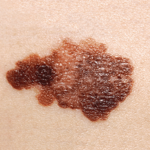 How To Get Rid Of Melanoma