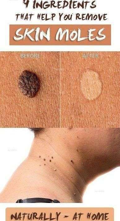 How to Get Rid of Moles Naturally and Fast ? in 2020 ...