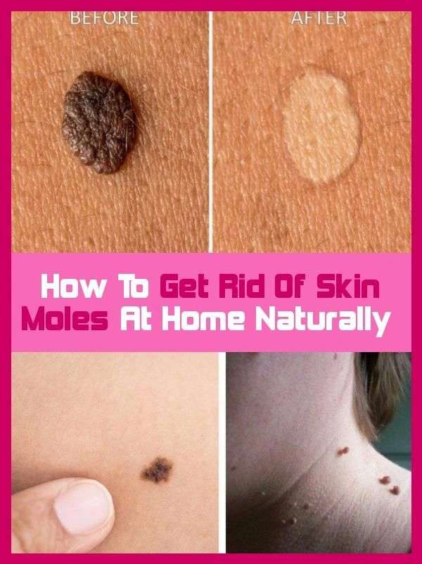 How To Get Rid Of Skin Moles At Home Naturally. in 2020 ...