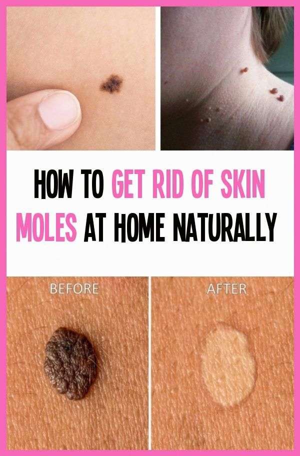 How To Get Rid Of Skin Moles At Home Naturally.