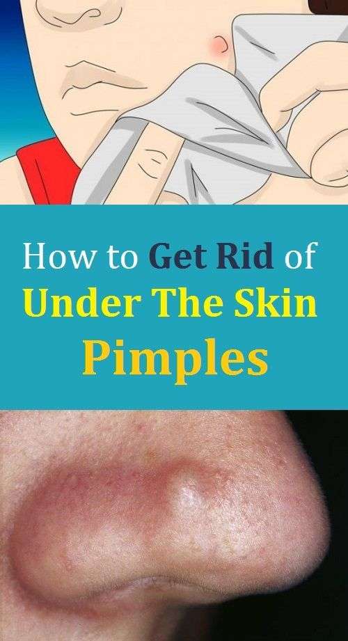 How to Get Rid of Under The Skin Pimples in 2020