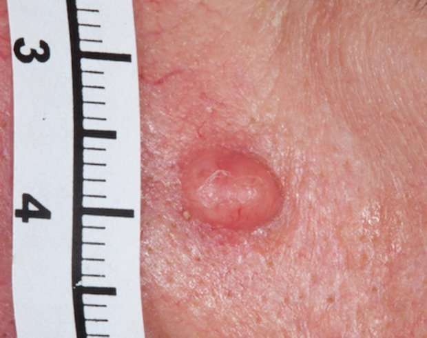 How to recognise a dangerous melanoma that doesn