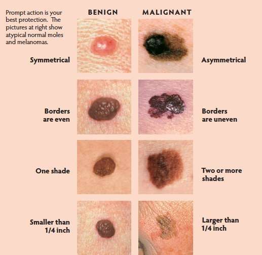 How to recognize skin cancer Â» Health and Fitness