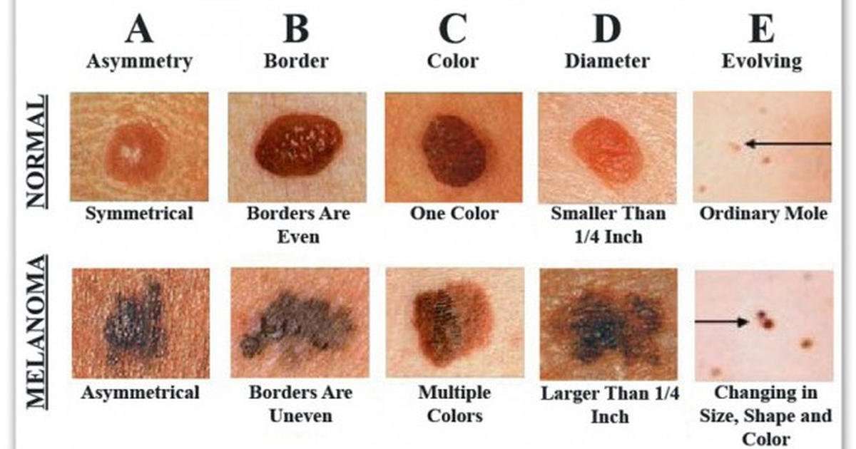 How To Recognize Skin Cancer â This Could Save Your Life