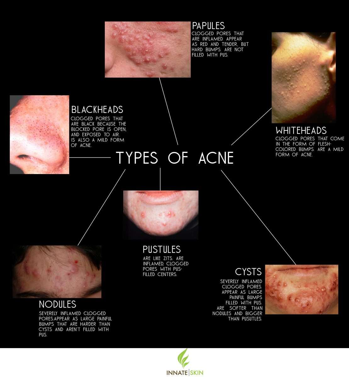 Different Types Of Bumps On Skin