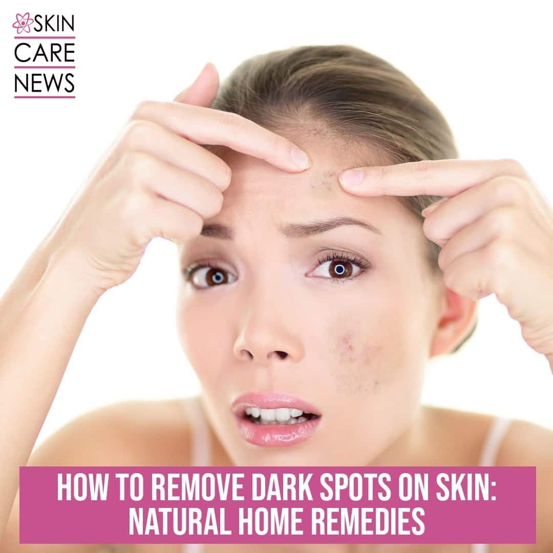 How To Remove Dark spots On Skin: Natural Home Remedies