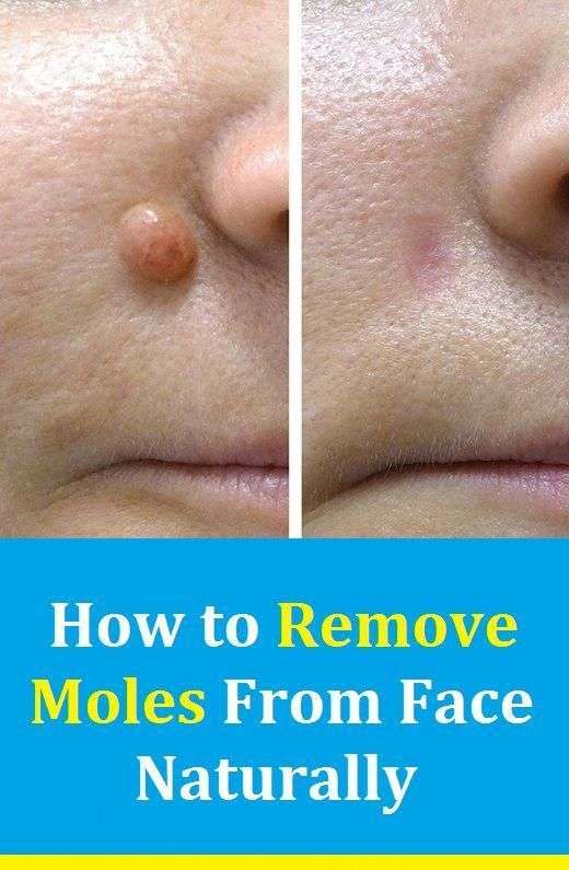 How to Remove Moles From Face Naturally and Quickly # ...
