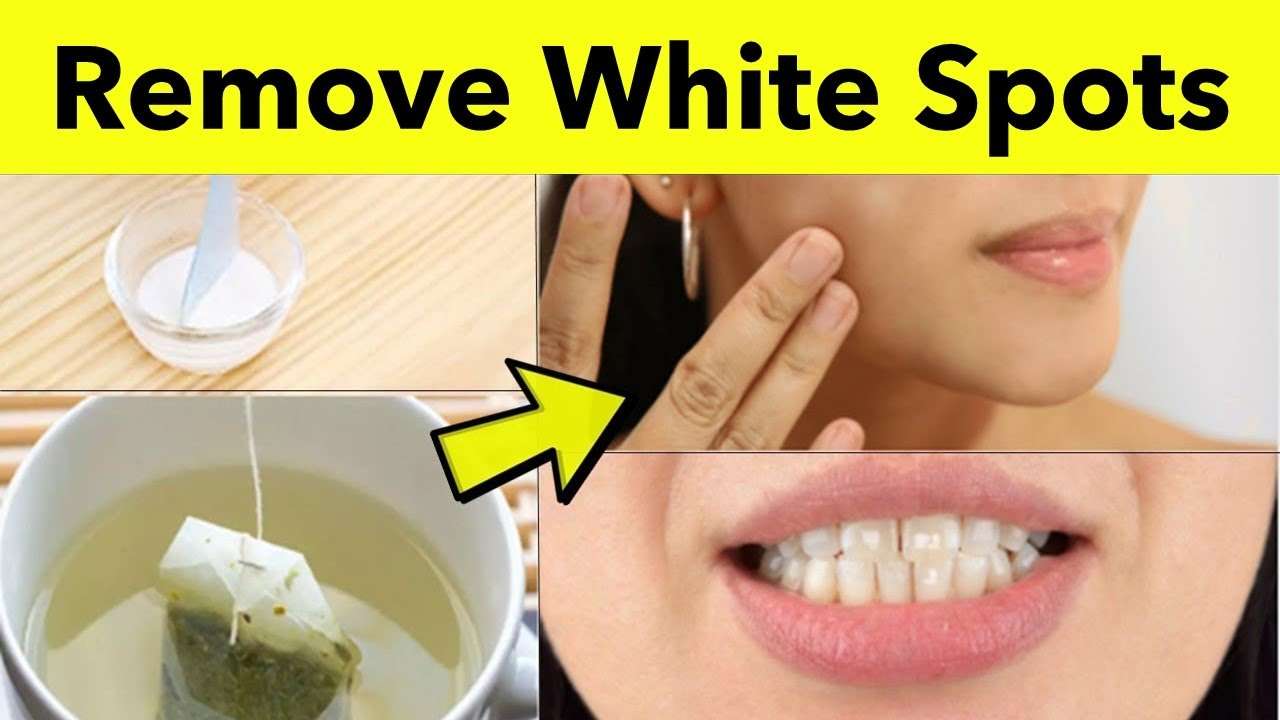How to Remove White Spots on Skin