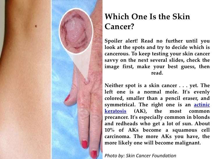 How To See If You Have Skin Cancer