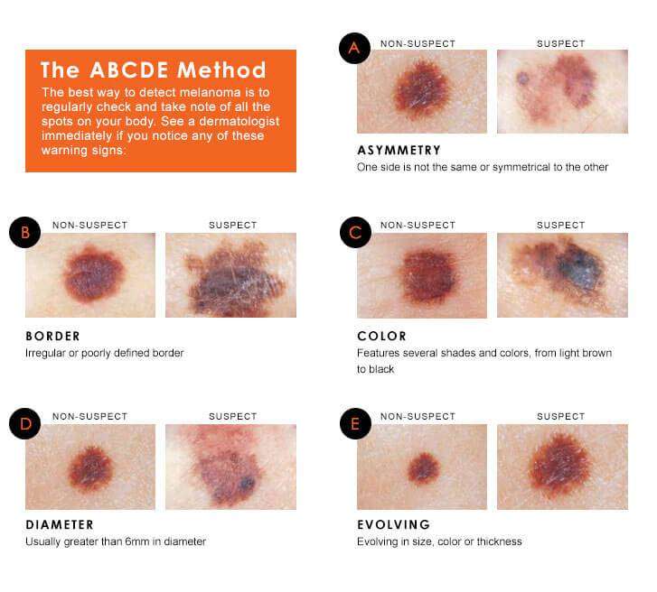 How To Spot The Early Signs Of Melanoma Skin Cancer