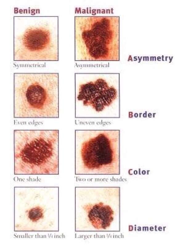 How to tell if a mole is skin cancer...this is good to ...
