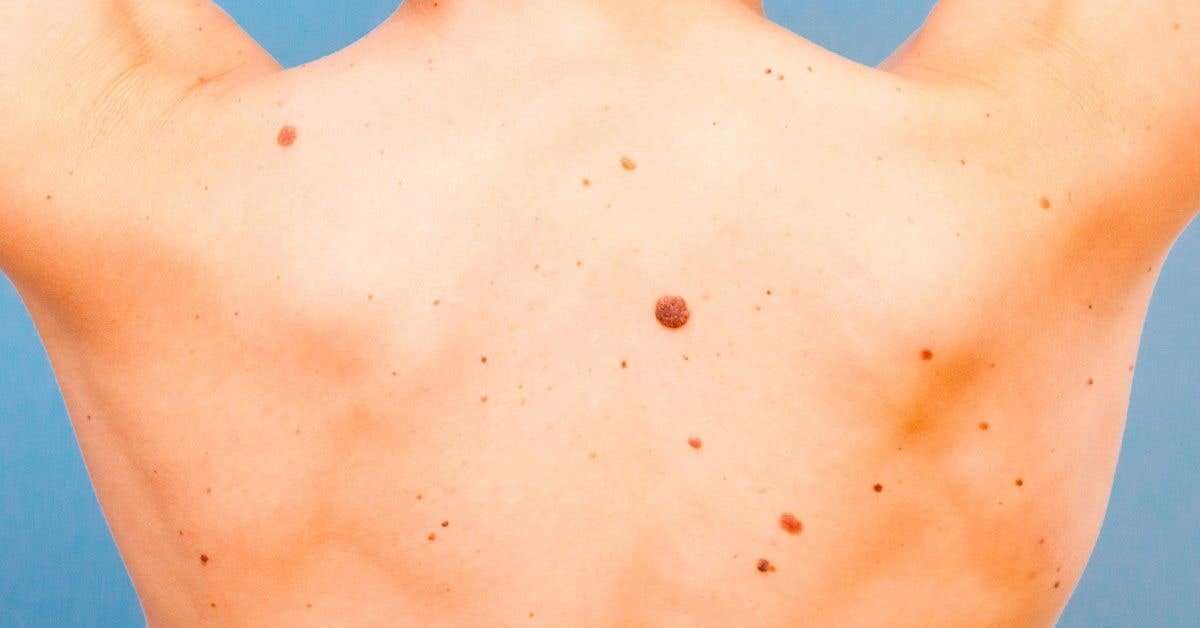 How to Tell if Moles Are Skin Cancer