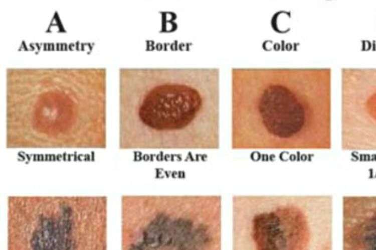 How To Tell If Skin Cancer Is Melanoma : Skin Cancer ...